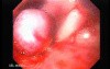Esophageal Varix - Bleeding and Ligated Varix