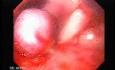 Esophageal Varix - Bleeding and Ligated Varix
