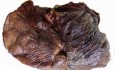 Lung Adenocarcinoma (5 of 5)