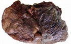 Lung Adenocarcinoma (5 of 5)