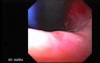 Esophageal Achalasia - Retroflexed View During Balloon Dilation