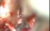 Epidermoid Cerebello Pontine Angle - Microsurgical Removal