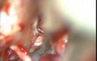 Epidermoid Cerebello Pontine Angle - Microsurgical Removal