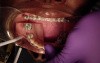 How To Apply Powerchain Correctly To Prevent Accidentally Rotating Teeth!