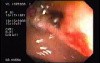 Tubulo - Villous Adenoma - Endoscopy (28 of 28)