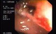 Tubulo - Villous Adenoma - Endoscopy (28 of 28)