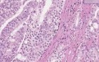 Prostate - Adenocarcinoma (Gleason grade 4) - Histopathology