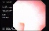 Tubulovillous Tumor (2 of 2)