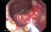 Multiple Adenomatous Polyps Of The Rectum (11 of 37)