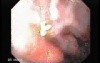 Gastroduodenal MALT lymphoma (2 of 9)
