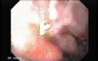Gastroduodenal MALT lymphoma (2 of 9)