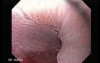 Gastric Heterotopia (inlet pach) -Magnif ication Endoscopy (3 of 4)