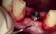 Paracrestal Incision - Uncovery Of Lower Anterior Implant