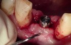 Paracrestal Incision - Uncovery Of Lower Anterior Implant
