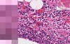 Acute Fibrinous Pericarditis