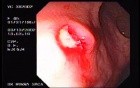 Rectal Amebiasis (1 of 2)