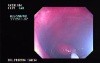 Endoscopic Polypectomy (2 of 2)