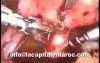 Laparoscopic Polymyomectomy