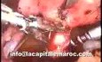 Laparoscopic Polymyomectomy
