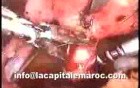 Laparoscopic Polymyomectomy