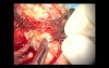 Second – Look Tympanoplasty With MFA Ossiculoplasty 