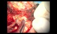 Second – Look Tympanoplasty With MFA Ossiculoplasty 