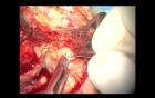 Second – Look Tympanoplasty With MFA Ossiculoplasty 