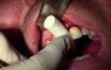 Extraction #8 With Socket Grafting II