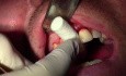 Extraction #8 With Socket Grafting II
