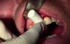 Extraction #8 With Socket Grafting II