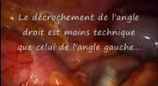 Laparoscopic Right Hemicolectomy