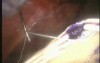 Laparoscopic repair of incisional hernia