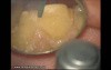 Initial Preparation For Aesthetic Veneers (4/4)