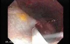 Huge Mass Of The Descending Colon (5 of 25)