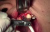 Final Osteotomy - Implant Surgery, #11 Site