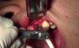 Final Osteotomy - Implant Surgery, #11 Site