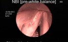 Assessment of Dysplatic Laryngeal Lesions