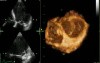 Mitral Valve Regurgitation