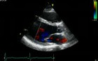 Echocardiography - Parasternal View - Normal Study