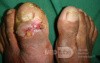 Left Hallux Osteomyelitis 