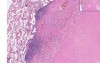Lung - Healed Granuloma