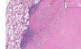 Lung - Healed Granuloma