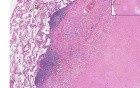 Lung - Healed Granuloma