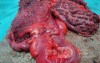 Multiple Rectal Ulcers (88 of 110)