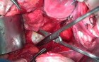 Anatomy of the Pelvis - Three Anterior Avascular Spaces
