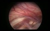 Endoscopy Inside The Brain