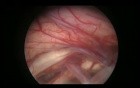 Endoscopy Inside The Brain