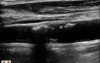 The Carotid Artery