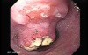 Small cell carcinoma of the lung that invades the upper and the middle third of the Esophagus (2 of 7)