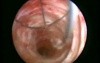Common Bile Duct Stone Removal - Laparoscopy